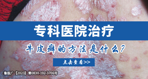 專科醫院治療牛皮癬的方法是什么