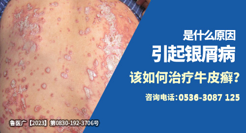 引起銀屑病如何治療牛皮癬
