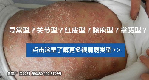 銀屑病類型如何辨別