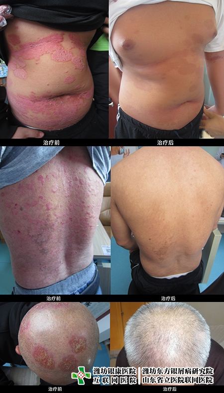 濰坊銀屑病研究院銀屑病康復案例
