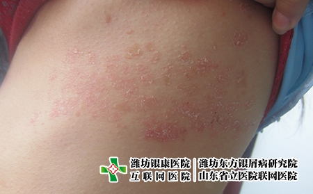 牛皮癬的治療及預防，牛皮癬治完了怎么防反復