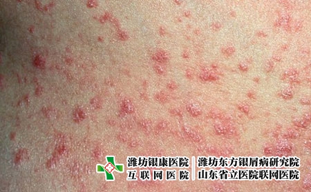 滴狀銀屑病2 滴狀銀屑病2