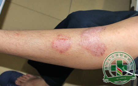 膿皰型銀屑病治療