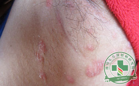 紅皮型銀屑病如何治療較危險小