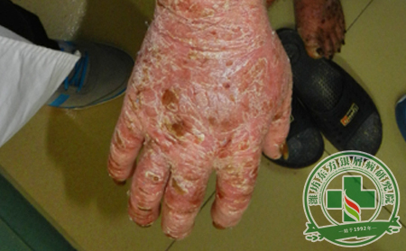 春季不感冒 兒童牛皮癬患者要多吃紅果蔬