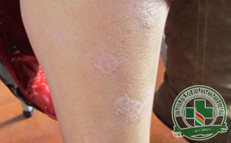 如何對尋常型銀屑病進行正確治療