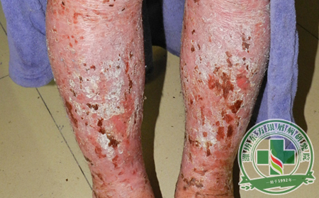 倒春寒牛皮癬患者要做好四件事