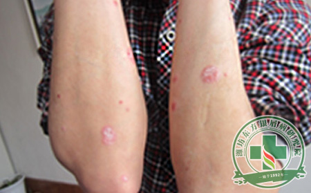 慢病慢治——淺談銀屑病治療