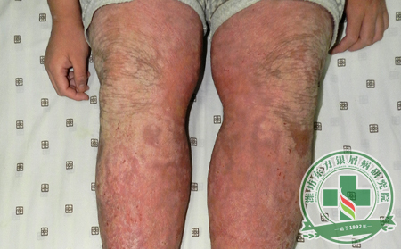 牛皮癬會對兒童造成哪些傷害