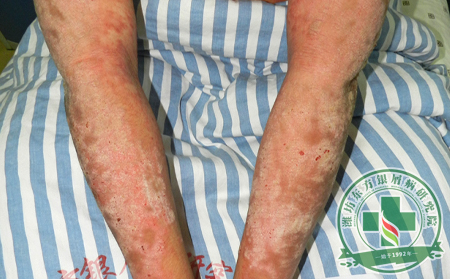 春節(jié)銀屑病患者吃火鍋禁忌事項(xiàng)