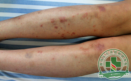 治療紅皮病型銀屑病應該注意什么