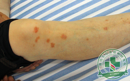 有關(guān)銀屑病關(guān)節(jié)炎日常護(hù)理常識(shí)