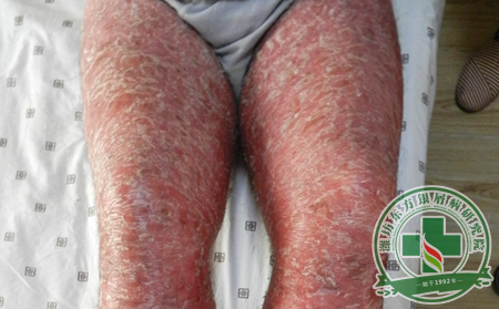 銀屑病護理應該注意什么細節(jié)問題