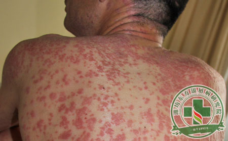 生活中銀屑病患者要注意什么