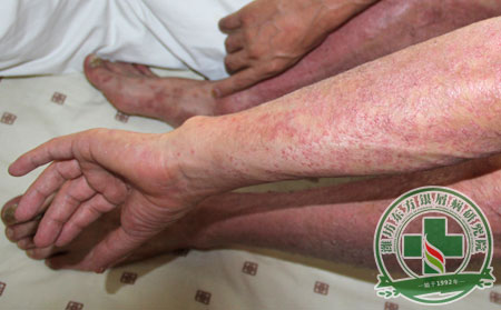 預防尋常型牛皮癬要注意哪幾點