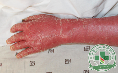 春季銀屑病患者謹防倒春寒