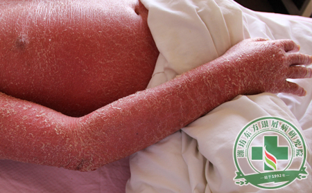 吃粗糧有利于牛皮癬恢復(fù)嗎