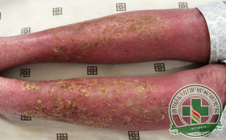 關節病型牛皮癬的危害有哪些