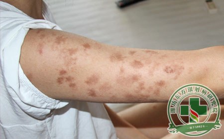 尋常型牛皮癬可分為哪幾種類型?