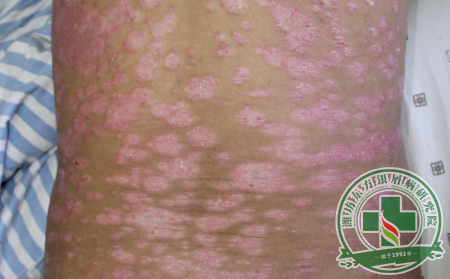 銀屑病的遺傳規(guī)律是怎樣的