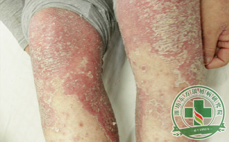 怎樣才能減少銀屑病復發