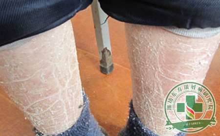 紅皮型牛皮癬的癥狀有哪些