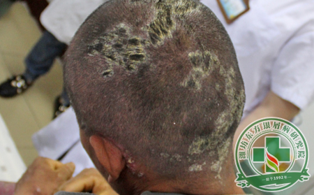 頸部銀屑病要怎么護(hù)理