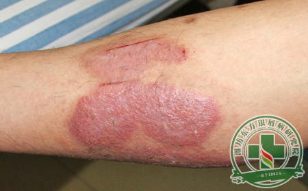 紅皮型銀屑病患者吃什么對身體可以