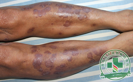 能夠誘發(fā)尋常型銀屑病的因素有哪些