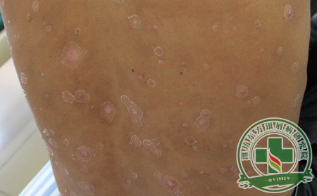 飾品與銀屑病的關(guān)系