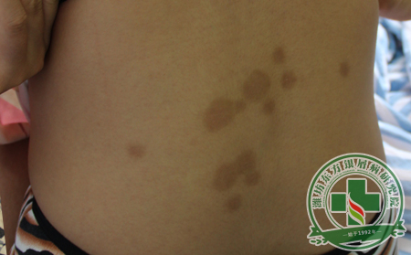 銀屑病患者不小心感冒了怎么辦