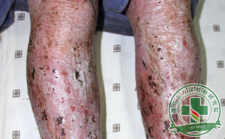 從細節著手，預防銀屑病