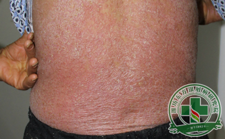 如何科學有效的治療銀屑病