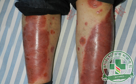 膿皰型銀屑病有哪些護理要點