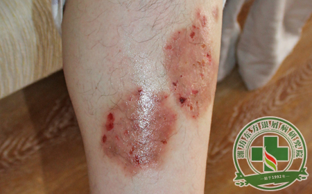 銀屑病為什么治療了多次還不能治好