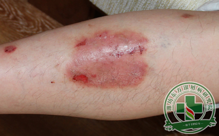 銀屑病患者如何護理保健康