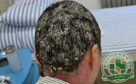 頭部銀屑病為什么會發作呢?