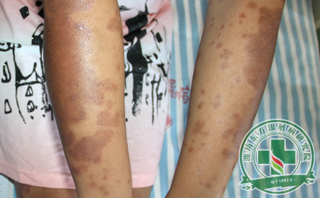 牛皮癬的甲損與灰指甲有什么區別