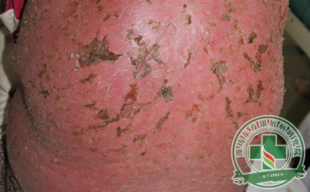 銀屑病患者日常的護理要訣