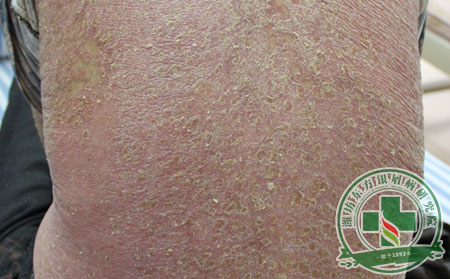 得了膿皰型銀屑病該怎么辦