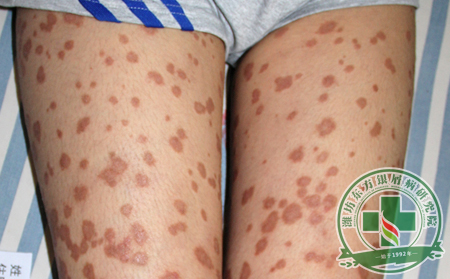 濰坊銀屑病醫院醫生講解銀屑病能否治好