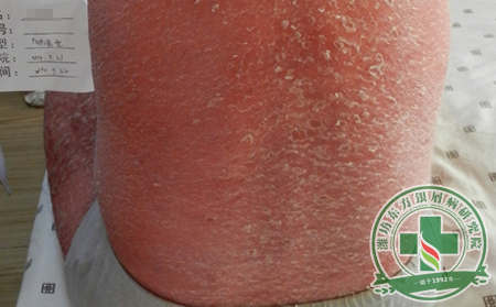 易與銀屑病混淆的幾種疾病