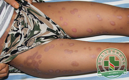 治療銀屑病什么季節比較好