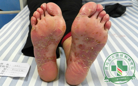 頭部銀屑病會(huì)給患者帶來(lái)哪些危害