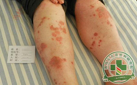 治療銀屑病良好的方法是什么？