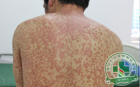 濰坊銀屑病醫(yī)院醫(yī)生簡述屈側(cè)尋常型銀屑病