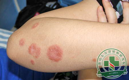 銀屑病的癥狀特征是什么樣?