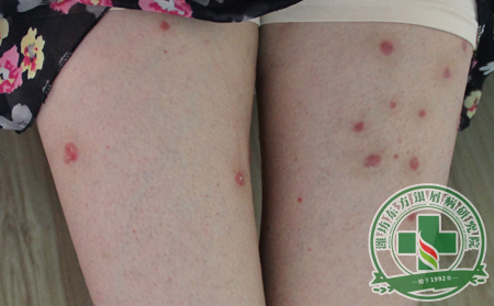 銀屑病為何越治越重