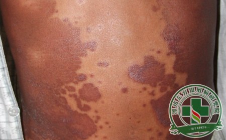 銀屑病久治不愈的原因有哪些