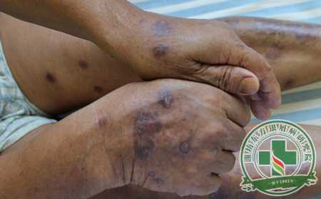 對銀屑病的癢有什么辦法?